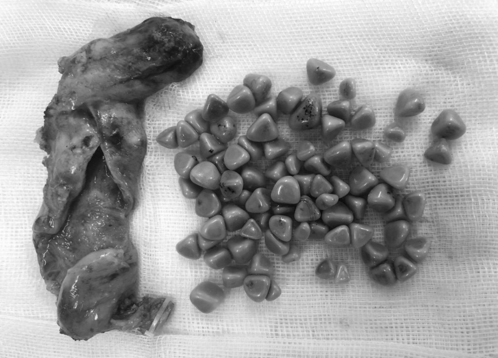 Túi mật chứa đầy sỏi là nguyên nhân khiến người phụ nữ đau bụng triền miên, nhiễm trùng đường mật. Ảnh: Bệnh viện cung cấp.