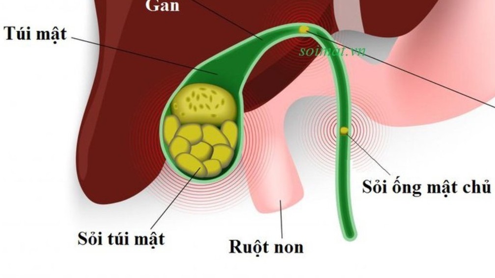 Túi mật hóa đá trong bụng người phụ nữ