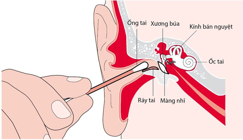 Hình minh họa lấy ráy tai bằng tăm bông. Ảnh: Bệnh viện cung cấp.