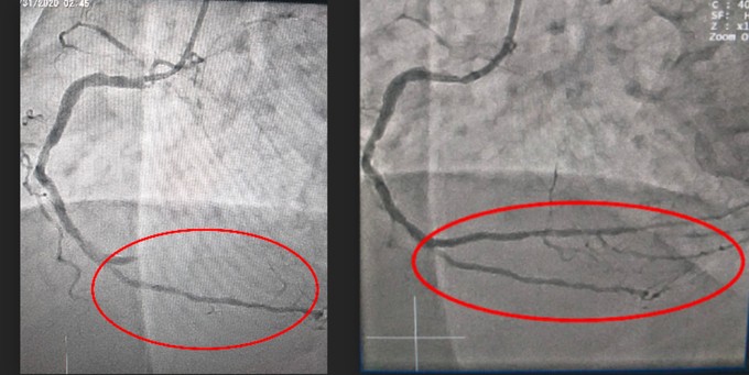 Hình ảnh mạch máu tắc nghẽn trước khi can thiệp (bên trái) và sau khi đặt stent tái thông (bên phải). Ảnh: Bệnh viện cung cấp.