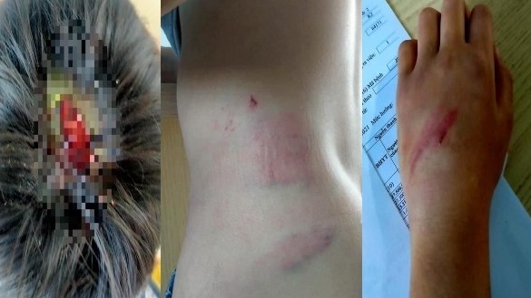 Bé trai 9 tuổi ở Gia Lai nghi bị cha đánh toác đầu, bầm tím người