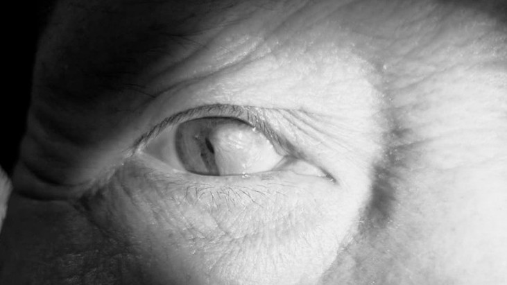 Mộng mắt nguy cơ gây mù