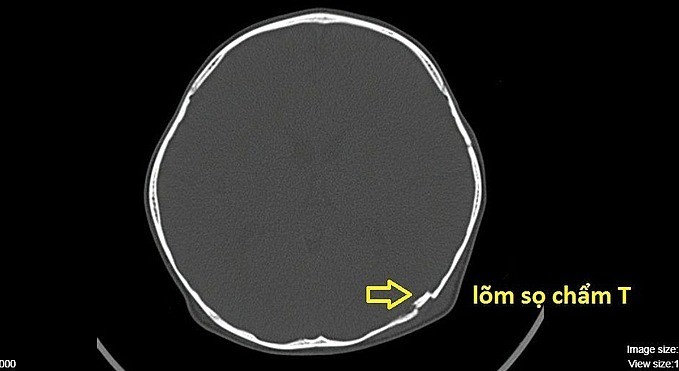 Hình ảnh chụp CT cho thấy sọ của cháu bé bị lõm. Ảnh do bệnh viện cung cấp.