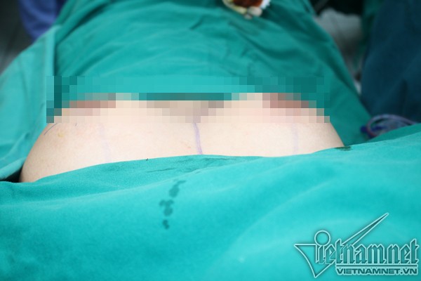 Ngực bệnh nhi được thu gọn sau ca phẫu thuật