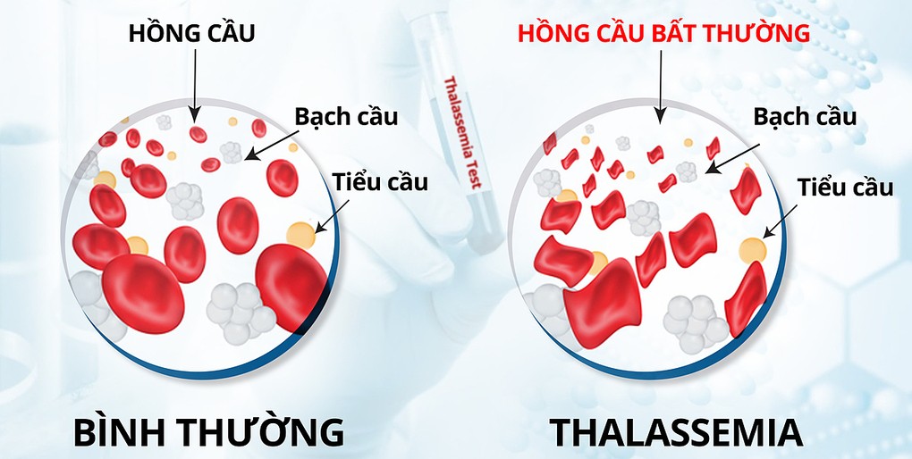 Hồng cầu của người bệnh Thalassemia khác với người bình thường. Ảnh do bệnh viện cung cấp.