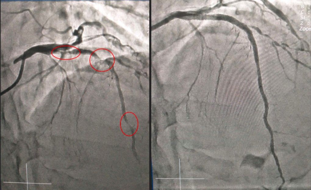 Ba đoạn nhồi máu cơ tim (bên trái) trước và sau khi được đặt stent mạch vành. Ảnh: Bệnh viện cung cấp.