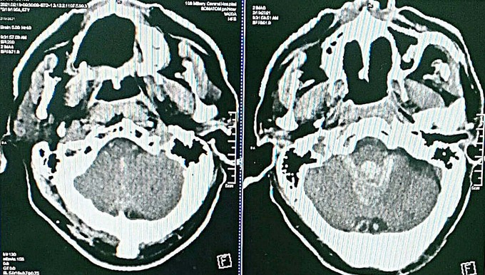 Hình ảnh CT não trước can thiệp, cho thấy chảy máu lụt não thất. Ảnh: Bệnh viện cung cấp.