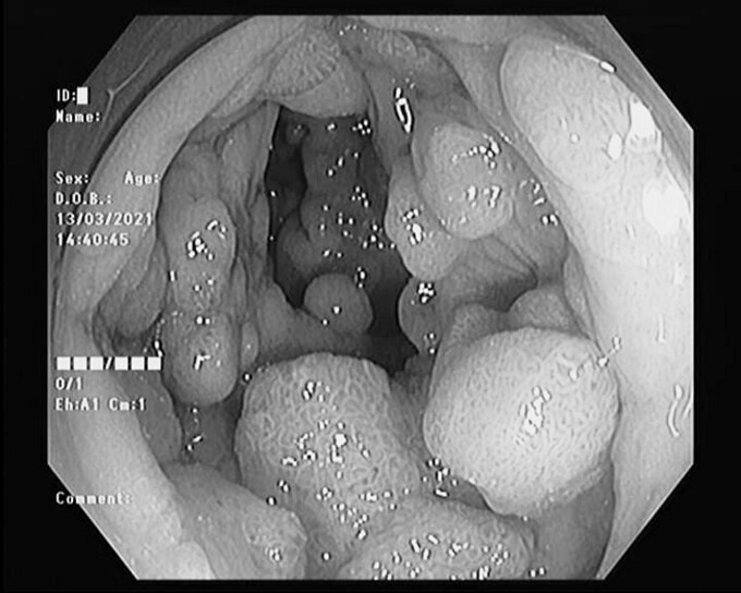 Hàng trăm polyp trong đại trực tràng bệnh nhân. Ảnh: Bệnh viện cung cấp