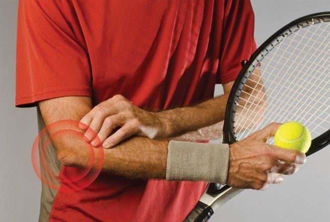 Viêm lồi cầu ngoài xương cánh tay hay còn gọi là hội chứng tennis elbow. Ảnh: Medicinaatualcancee