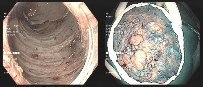 Hình ảnh các khối sùi lớn ken đặt lòng trực tràng (ảnh phải)  và hình ảnh sau khi được cắt bỏ