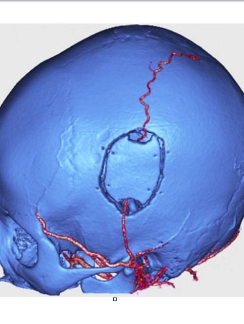 Ảnh chụp sọ não và mạch máu sau cuộc phẫu thuật bắc cầu. Ảnh: Bác sĩ cung cấp.