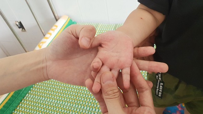 Bệnh tay chân miệng ở Quảng Nam tăng gấp 7,5 lần