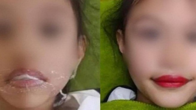 Livestream xăm môi cho con gái 5 tuổi để quảng cáo TMV: Bác sĩ cảnh báo gì?