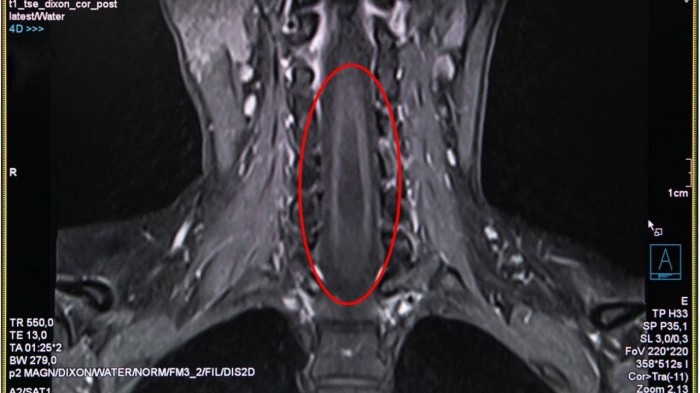 Kết quả chụp MRI thể hiện rõ căn bệnh hiếm rỗng tủy