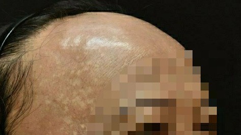 Bệnh lạ khiến người phụ nữ rụng tóc, hói nửa đầu