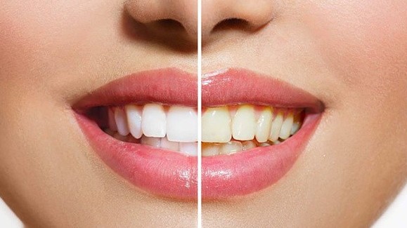 Nguyên nhân răng của bạn ngả màu vàng