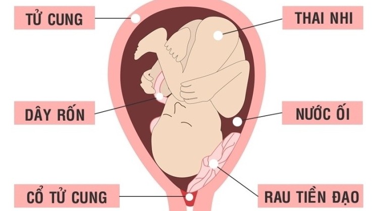 Bệnh nhau tiền đạo