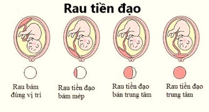 Các vị trí nhau tiền đạo - Ảnh minh họa