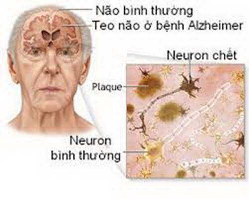 Bệnh Alzheime - Ảnh minh họa