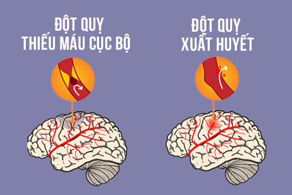 Các loại đột quỵ