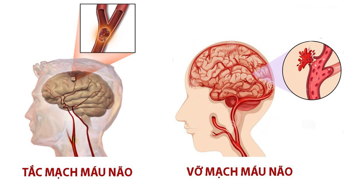 Đột quỵ là gì?