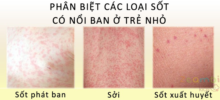 Phân biệt sốt phát ban và sởi