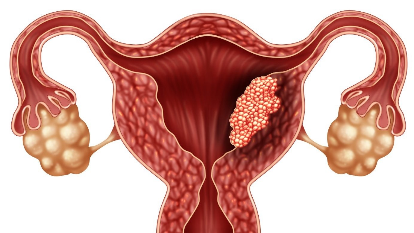 Chảy máu sau mãn kinh: Dấu hiệu đáng tin cậy của ung thư nội mạc tử cung