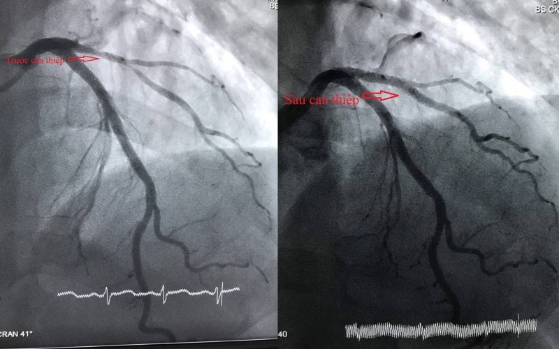 Các bác sĩ tiến hành can thiệp mạch vành cho bệnh nhân.