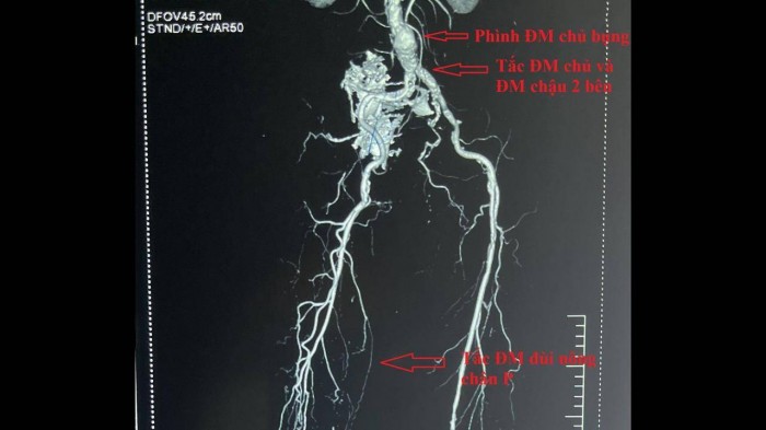 Hình ảnh chụp cắt lớp vi tính có cản quang.