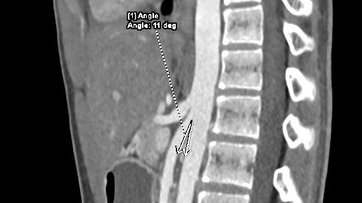 Kết quả CT cho thấy góc động mạch mạc treo tràng trên – động mạch chủ của người bệnh chỉ 110 so với bình thường là 300.