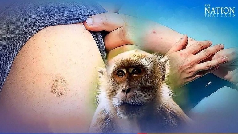 Thái Lan: Vaccine đậu mùa có khả năng bảo vệ khỏi bệnh đậu mùa khỉ
