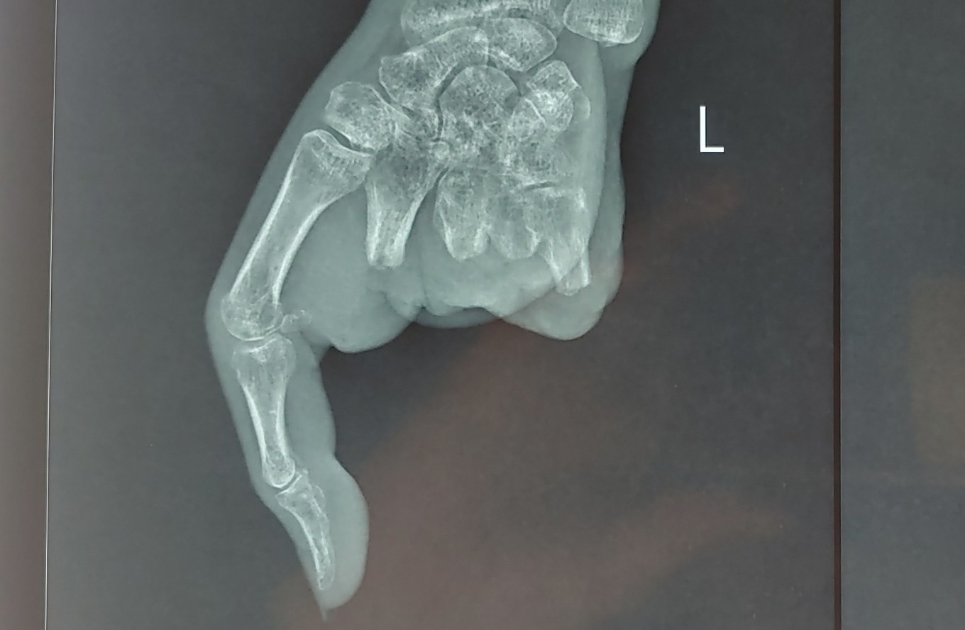 Ảnh X-quang bàn tay trái của bệnh nhân bị cắt bỏ 4 ngón. Ảnh: Bệnh viện cung cấp