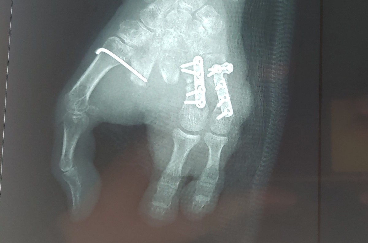 Ảnh chụp X-quang bàn tay trái của bệnh nhân sau khi ghép hai ngón chân thành ngón tay út và áp út. Ảnh: Bệnh viện cung cấp