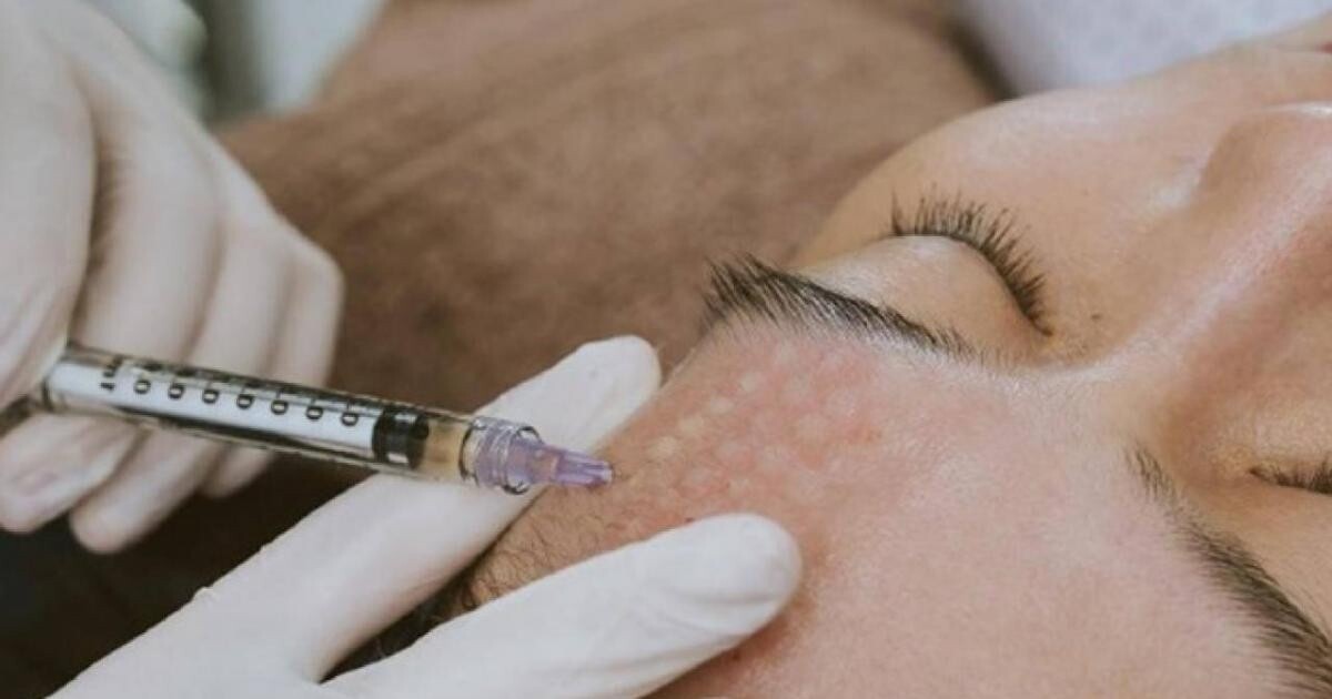 Cẩn trọng biến chứng sau tiêm mesotherapy làm đẹp