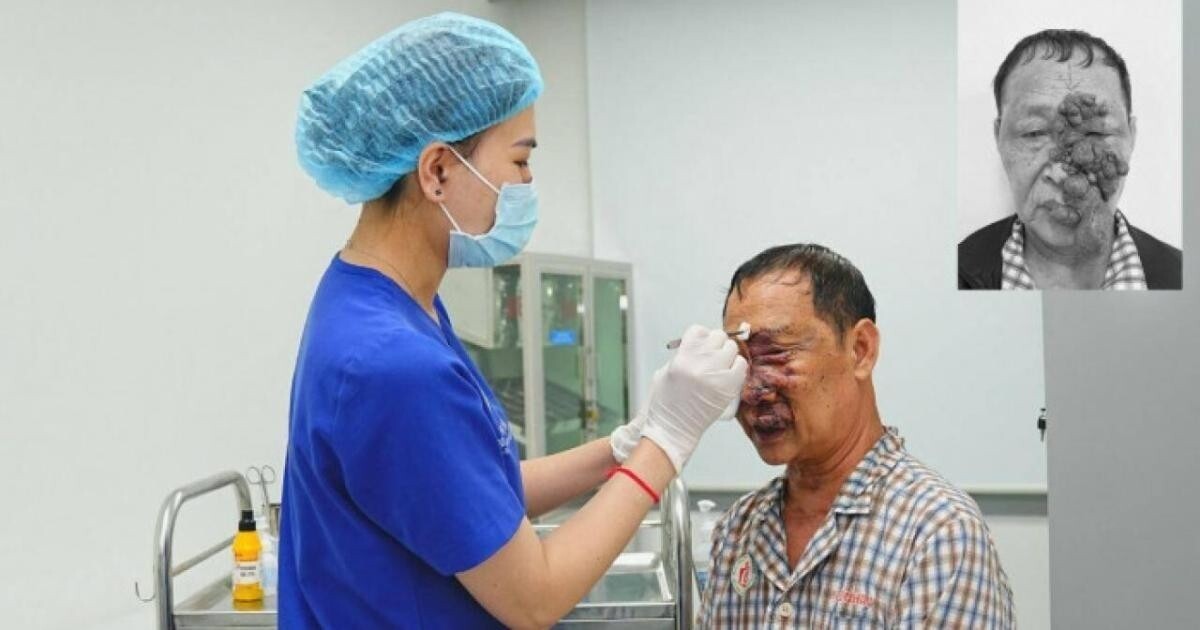 Ông T. trước và sau khi phẫu thuật bóc tách khối u dị dạng mạch máu lớn như chùm nho trên khuôn mặt