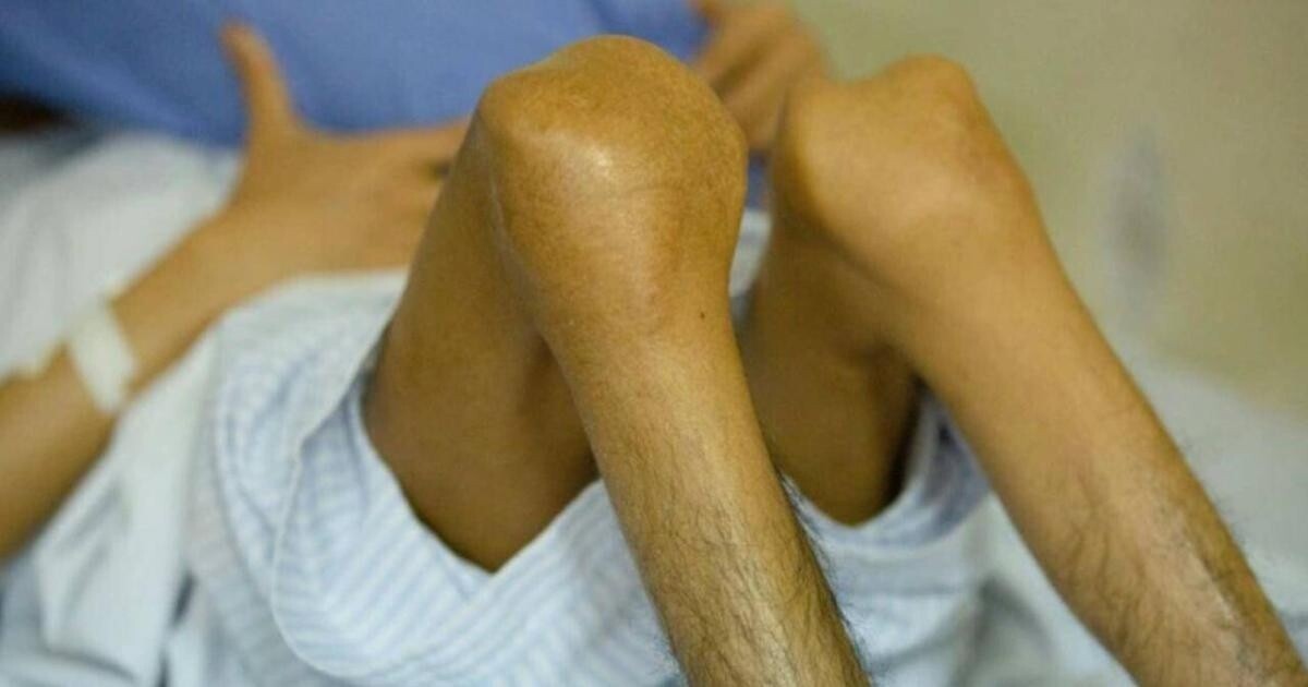 Bệnh nhân Thiết mất 1 chân vì bệnh máu khó đông