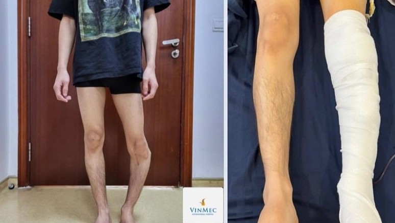"Nắn thẳng" cẳng chân cho bệnh nhân có góc vẹo chân hơn 50 độ