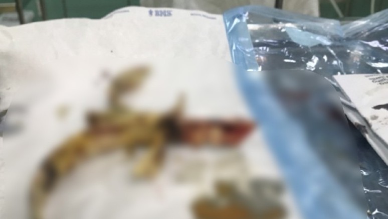 Phẫu thuật cứu sống bệnh nhân bị dị vật cắm chặt vào hộp sọ