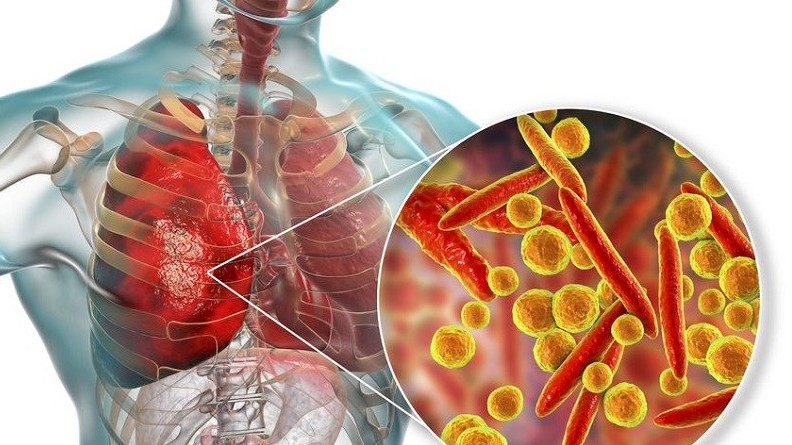 Gia tăng trẻ gặp biến chứng viêm phổi do vi khuẩn mycoplasma pneumoniae