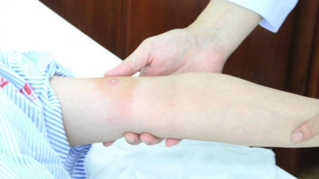 Người phụ nữ ở Bạc Liêu bị ong đốt gây biến chứng nguy hiểm