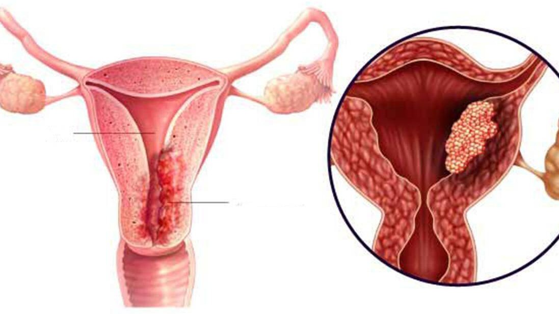 Dấu hiệu nào phát hiện ung thư niêm mạc tử cung?