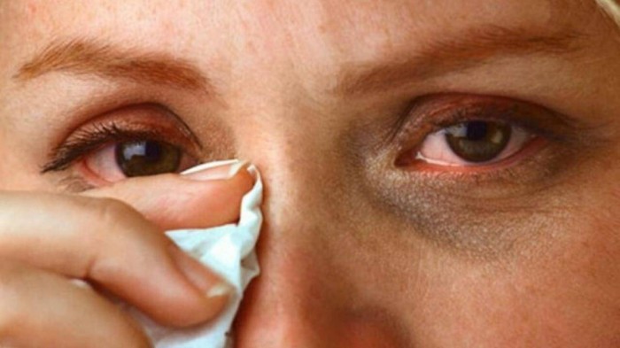 Dấu hiệu điển hình của đau mắt đỏ.