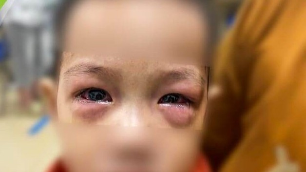 Bảo vệ trẻ em trước dịch đau mắt đỏ