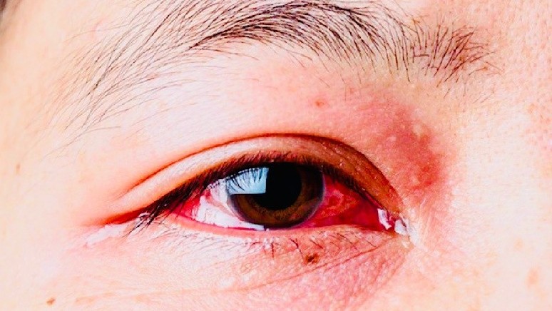 Bệnh đau mắt đỏ đang có nguy cơ bùng phát ở Hải Phòng