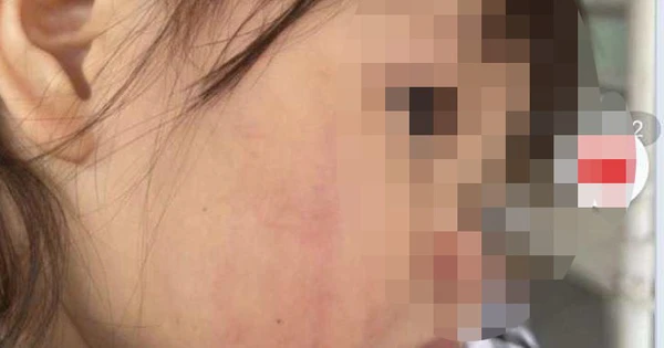 Bé 2 tuổi bị cô giáo tát liên tiếp khiến mặt sưng đỏ, vỡ thành mạch và xuất huyết trong.