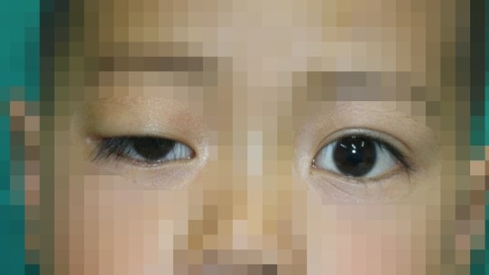 Sụp mi mắt ở trẻ nhỏ có nguy hiểm?