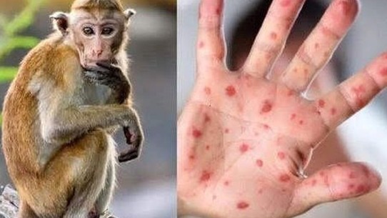 Long An: Phát hiện người đàn ông dương tính với virus đậu mùa khỉ