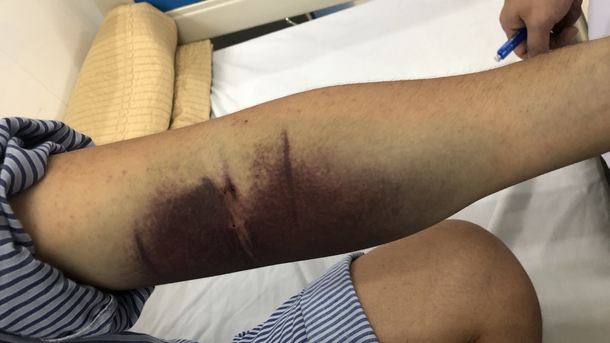 Vết xuất huyết tím đen trên cánh tay bệnh nhân mắc sốt xuất huyết.
