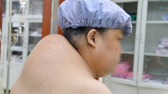 Khối u mỡ khổng lồ gây biến dạng vai gáy người phụ nữ ở Hà Nội