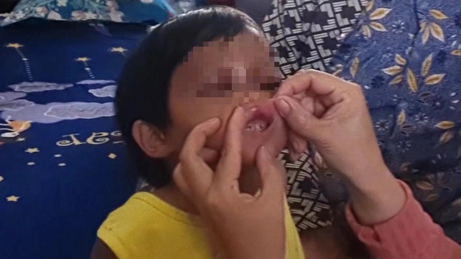 Bảo vệ khẩn cấp bé gái 4 tuổi ở Cà Mau bị cha nuôi đánh đập